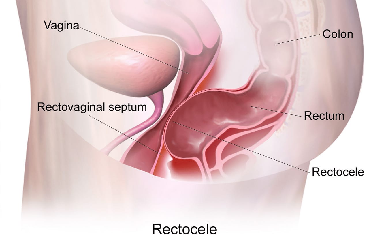 Rektosel Nedir ?